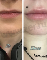 Увеличение губ, препарат Juvederm Ultra Smile